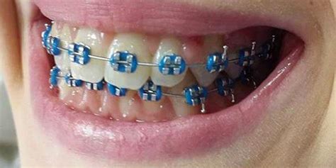 navy blue color braces.